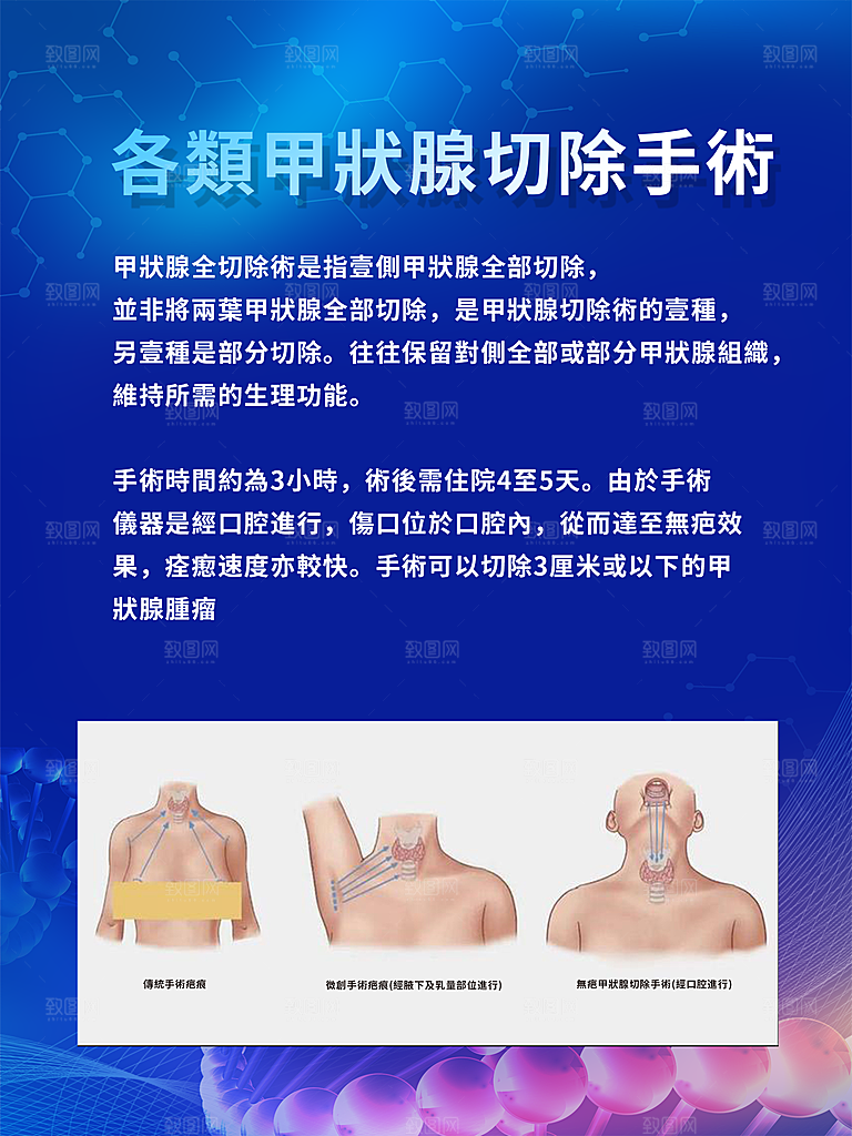 各類甲狀腺切除小图繁体字海报