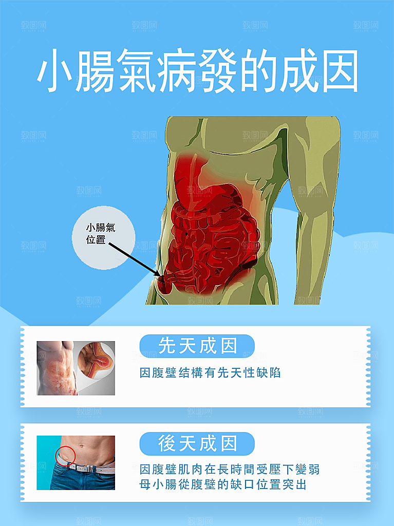 小腸氣病發的成因小图繁体字海报