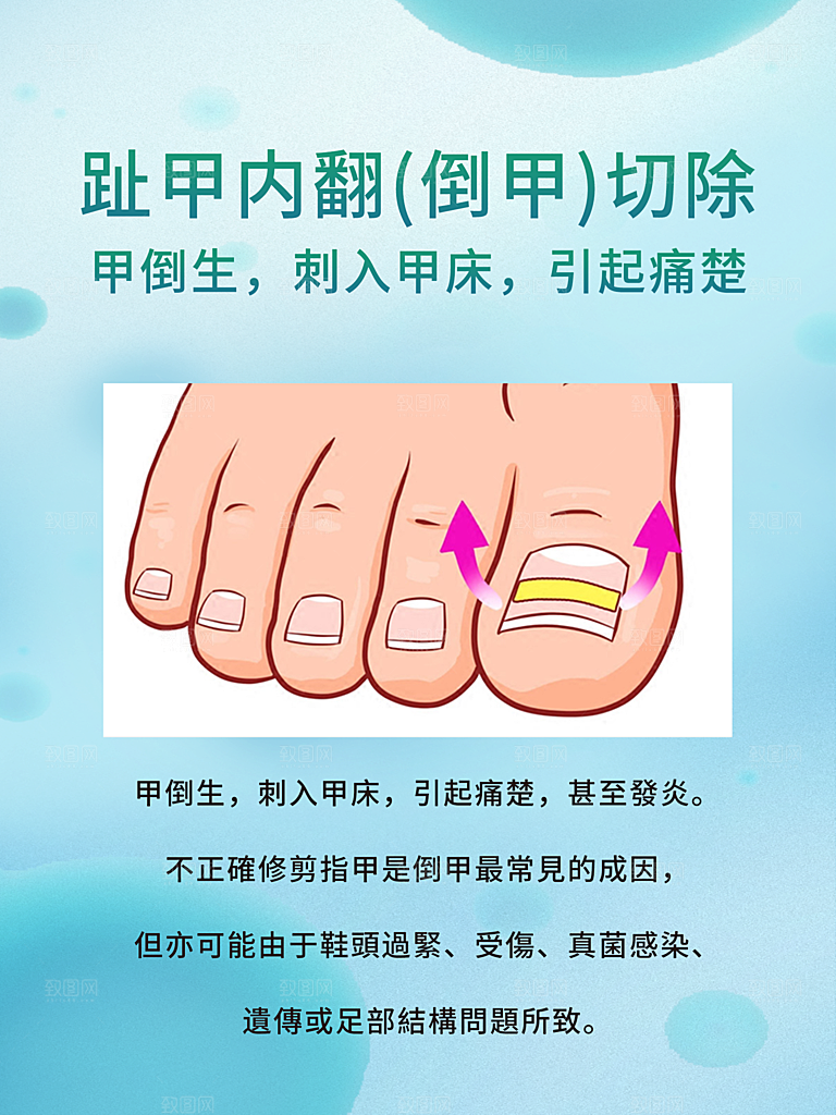 趾甲内翻倒甲切除繁体字海报